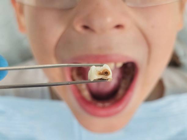 Best Emergency Dental Care for Broken or Chipped Teeth in Canton, SD